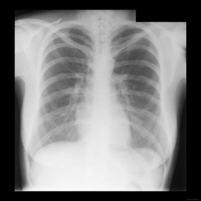 A normal chest x-ray showing all contours, the two lung parenchyma and pulmonary vessels with the bronchi branches