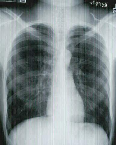 Tobacco smoke contains over 40 different carcinogens and it is associated with an increase risk of cancer in the gastrointestinal tract (Oral cavity, esophagus, stomach and pancreas).