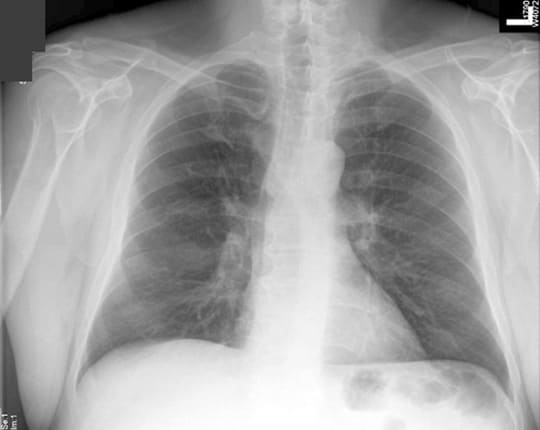 Eccentric calcification of the lesion and increasing size are also risk factors of malignancy in such a situation.