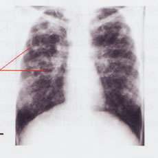 The main function of the Lungs is to provide gas exchange between inspired air (supplying oxygen) and blood in the pulmonary circle.