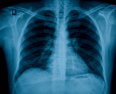 Expiration is a passive process, relying on the elastic recoil of the lung and chest wall. During exercise, ventilation is increased and expiration becomes active, with contraction of the muscles of the abdominal wall and the internal intercostals.
