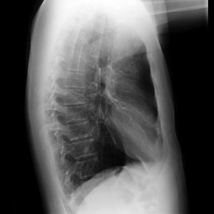 Cigarette smoking is a risk factor for ischemic heart disease and peripheral vascular disease and is the major cause of chronic obstruction pulmonary disease (COPD).