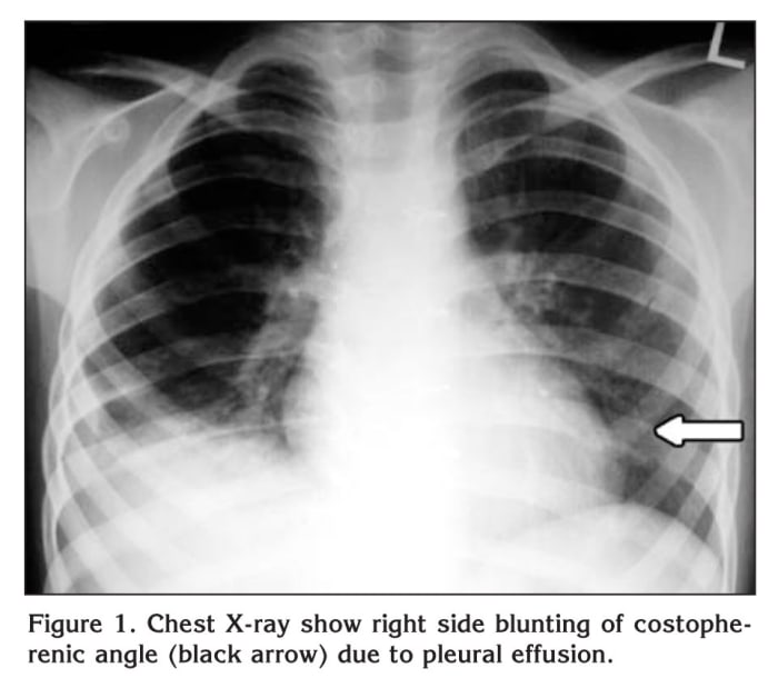 The right lung is divided into three lobes, whereas the left lung has two. The Trachea divides at the carina into right and left main Bronchi