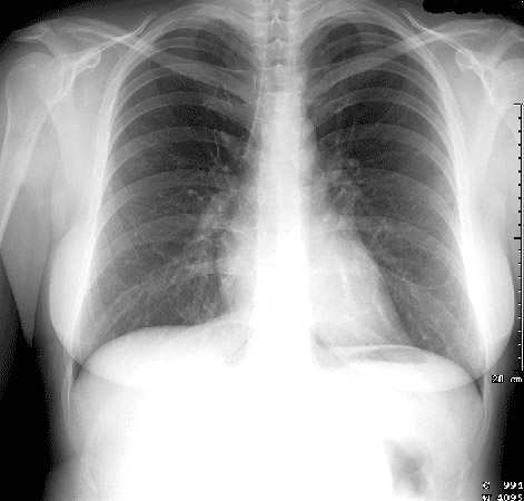 A normal chest x-ray showing all contours, the two lung parenchyma and pulmonary vessels with the bronchi branches
