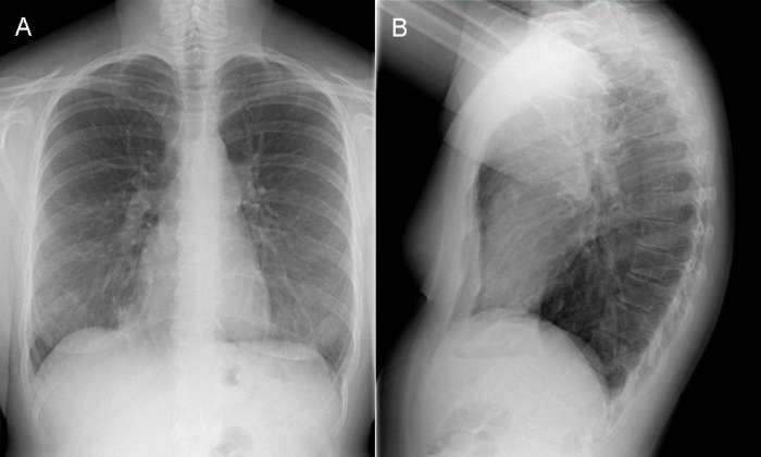 A normal chest x-ray showing all contours, the two lung parenchyma and pulmonary vessels with the bronchi branches