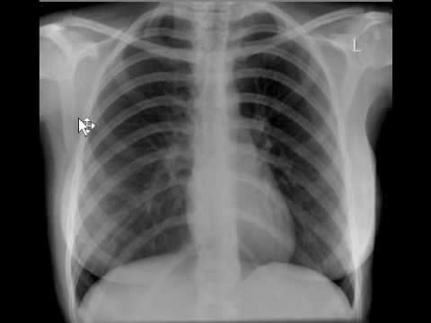 Individually targeted smoking in public places has reduced smoking prevalence. Individually targeted smoking cessation strategies are best delivered by a smoking cessation clinic and are non-pharmacological.