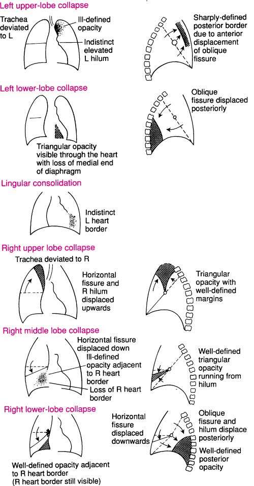 A normal chest x-ray showing all contours, the two lung parenchyma and pulmonary vessels with the bronchi branches