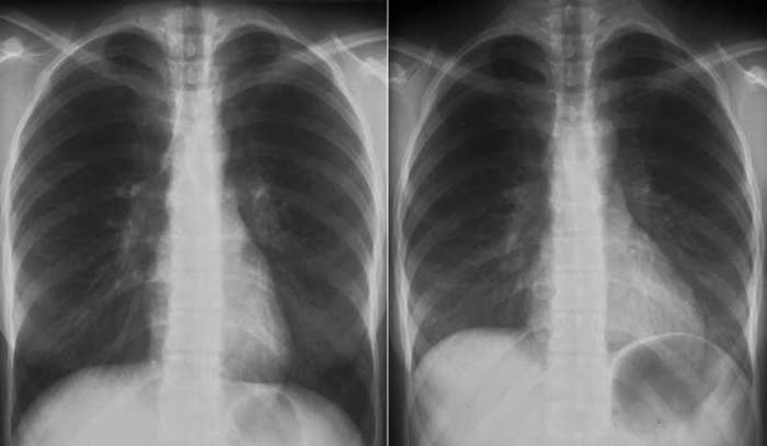 Inspiratory ariflow is achieved by creating a sub-atmospheric pressure in the alveoli by increasing the volume of the volume of the thoracic cavity under the action of the inspiratory muscles.
