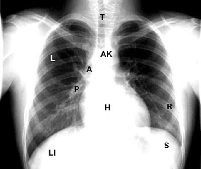 Reading The Chest X-Ray (Chest Radiography): Identifying A Normal Chest ...