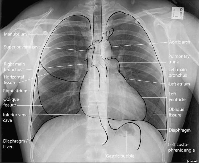 A normal chest x-ray showing all contours, the two lung parenchyma and pulmonary vessels with the bronchi branches