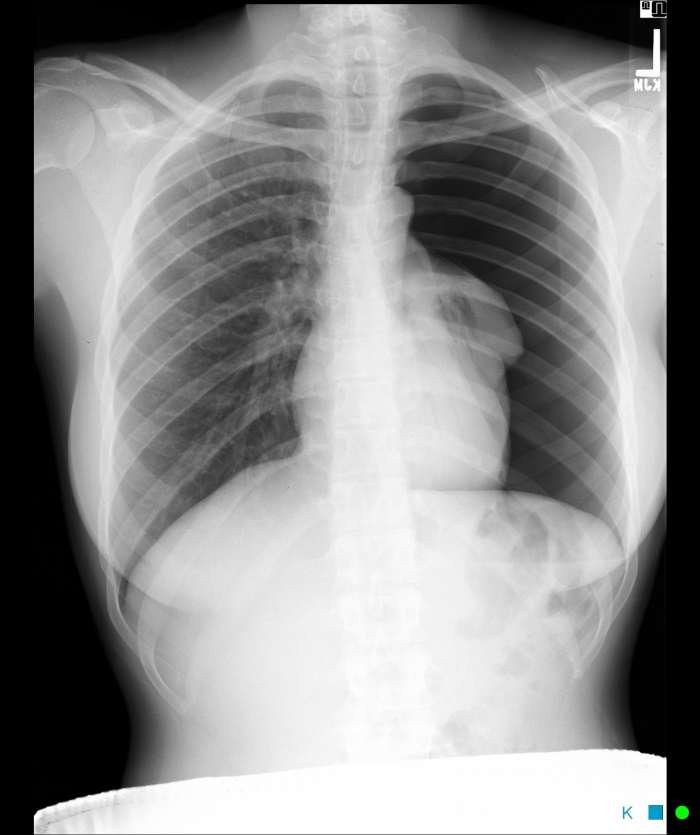Respiratory function tests include simple outpatient investigations to assess airflow limitation and lung volumes. Normal values vary for age, sex and height,, and also between individuals.
