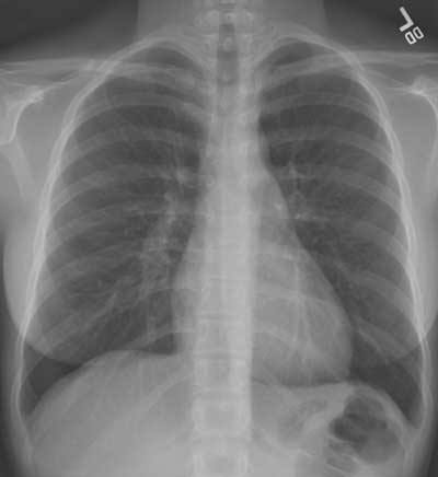 A normal chest x-ray showing all contours, the two lung parenchyma and pulmonary vessels with the bronchi branches