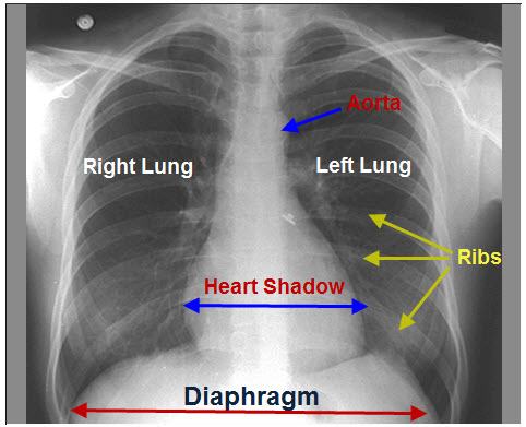 A normal chest x-ray showing all contours, the two lung parenchyma and pulmonary vessels with the bronchi branches