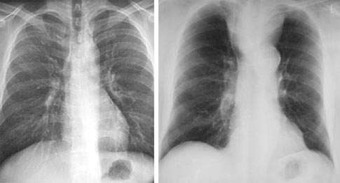 Routine films are taken postero-anteriorly (PA), i.e the fil is placed in front of the patient with the x-ray source behind.