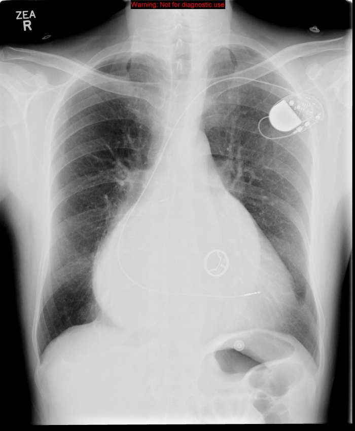 The parietal pleura lines the inside of the thoracic cavity. The interpleural space between these layers normally contains only tiny amount of lubricating fluid.