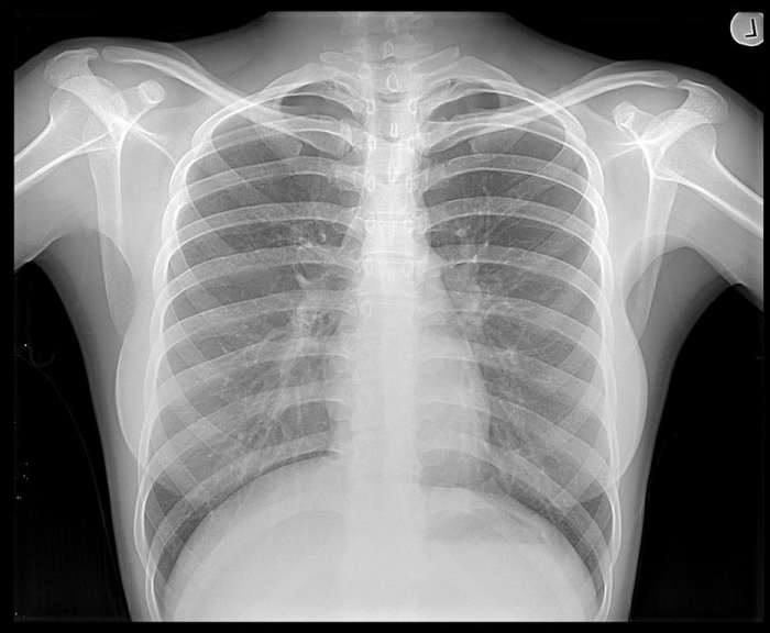 AP films are taken only in patients who are unable to stand; the cardiac outline appears bigger and the scapulae cannot be moved out of the way.