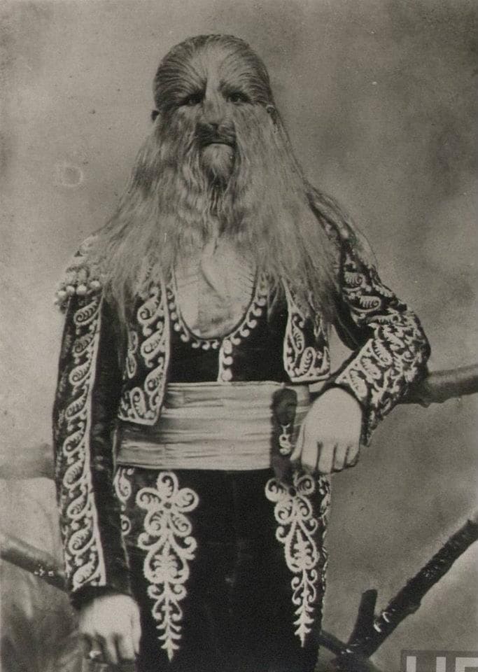 Stephan Bibrowsky (1890-1932), known as Lionel the Lion-Faced Man. Sideshow performer for Barnum & Bailey’s Circus.