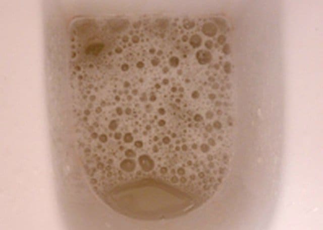 foamy-urine-causes-treatment-hubpages