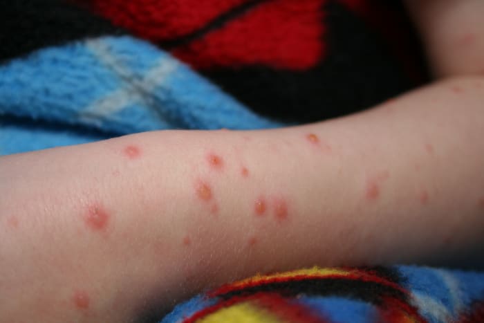 Chicken pox, like the case this poor kid is suffering, is where shingles comes from.