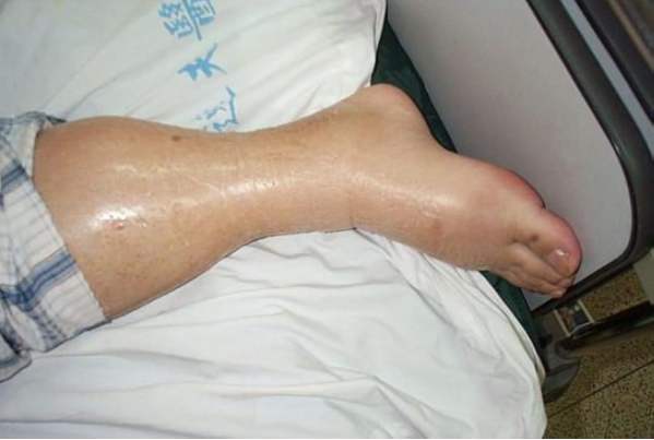 pictures of swollen ankles due to congestive heart failure