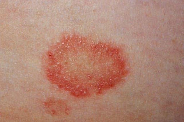 Ringworm Images Causes Symptoms Treatment Hubpages