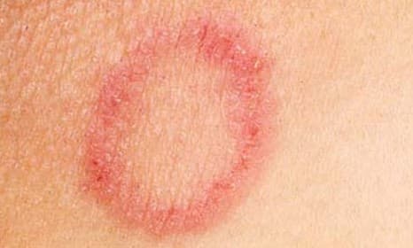 Ringworm – Images, Causes, Symptoms, Treatment - HubPages