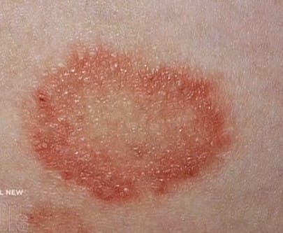 Ringworm – Images, Causes, Symptoms, Treatment - HubPages