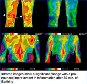 Infrared images show a significant change with a pronounced improvement of inflammation after 30 minutes of earthing.