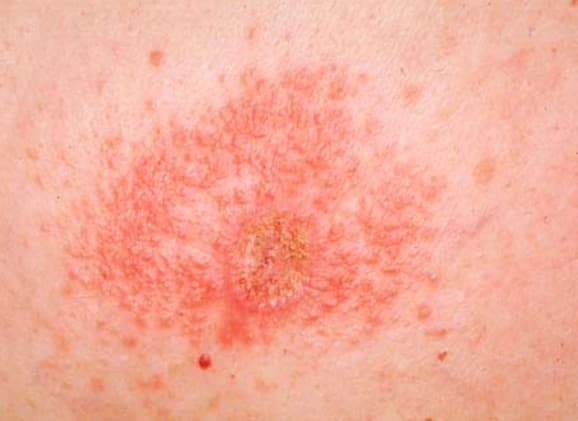 Contact Dermatitis - Pictures, Symptoms, Causes, Treatment - HubPages