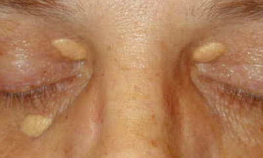 Xanthelasmas - Pictures, Treatment, Removal, Symptoms - HubPages