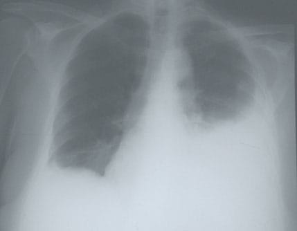 Pleurisy In Chest X-Ray: Various Radiographs To Show And Depict This ...