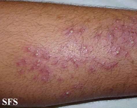 Bacterial folliculitis