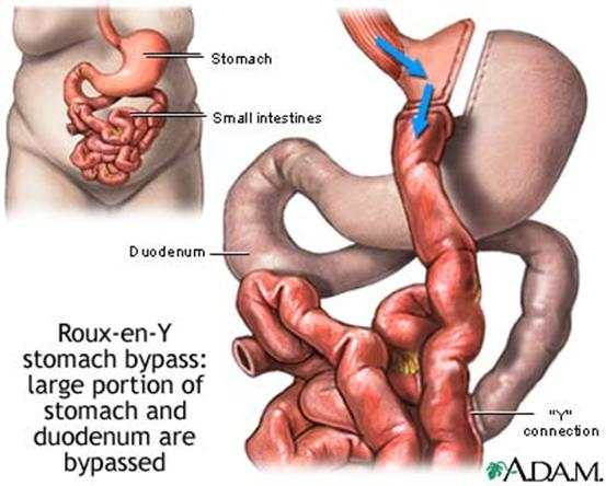 Restrictive gastric operations, such as an adjustable gastric banding procedure, serve only to restrict and decrease food intake and do not interfere with the normal digestive process. In this procedure, a hollow band made of special material is plac