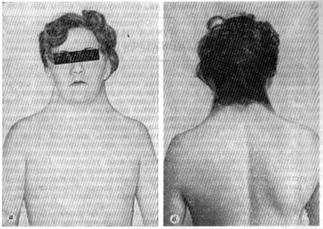 These boys have a normal XY karoytype, some of the features of Turners syndrome (such as hypertelorism, short stature, epicanthal folds, and right sided congenital heart disease), and various skeletal malformations. In contrast to Turners syndrome,