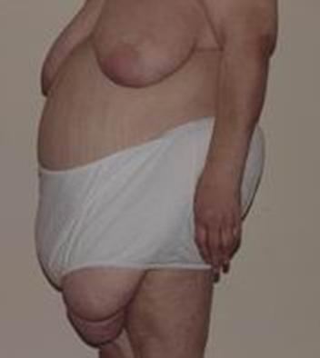Obesity in not a condition for which a precise definition is particularly useful. Unlike many real diseases, obesity represents one arm of distribution curve of body fat or body weight, with no sharp cut-off point. Its importance lies in the many, of
