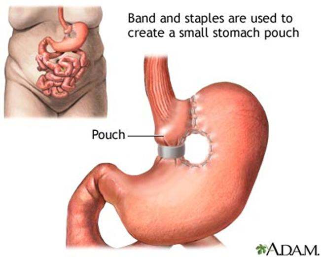 Restrictive gastric operations, such as vertical banded gastroplasty (VGB), serve only to restrict and decrease food intake and do not interfere with the normal digestive process. In this procedure the upper stomach near the esophagus is stapled vert