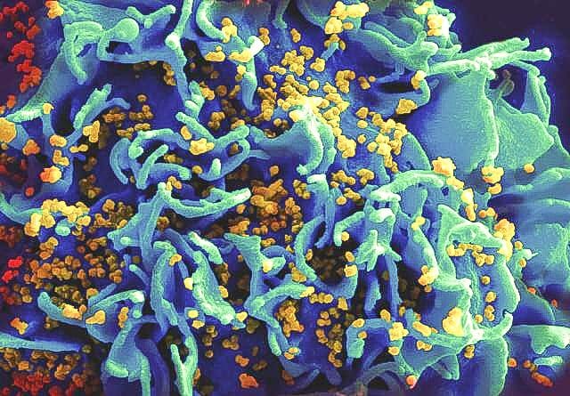 A scanning electron micrograph of a T cell releasing HIV virions. The picture is colourized for clarity. The blue and green object is the T cell and the yellow particles are the virions.