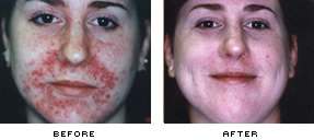 This before and after picture from drluftman.com shows the results that can be achieved with photofacial treatment
