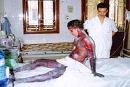 Typical effects of contaminated bile: dark patches on skin, severe jaundice, cirrhosis of the liver.