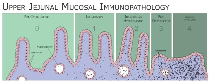 Flattening of intestinal villi in a person with untreated celiac disease