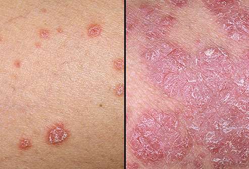 if you can stomach it examine psoriasis photos and take note of the total absence of follicles probably due to modern chemical defoliation.