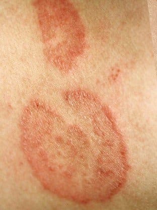 Tinea Corporis - Pictures, Treatment, Causes, Symptoms - HubPages