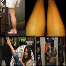 700 × 700 Search by image Kim Kardashian Could Have Cured Her Psoriasis If She Only Knew How – Click Here to Find Out. Kim Kardashian has Psoriasis