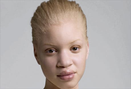 Note: I am not confirming that albinism is leprosy. This picture is used just to address the argument they use.