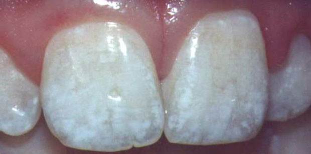 Dental fluorosis is a reflection of what's happening in our bones and is the first visible sign of fluoride poisoning Picture courtesy of http://www.fluoridation.com/teeth.htm