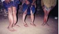 Deformities caused by Fluorosis. Picture courtesy of http://www.gaia-health.com/articles51/000081-Fluoridated-Salt.shtml