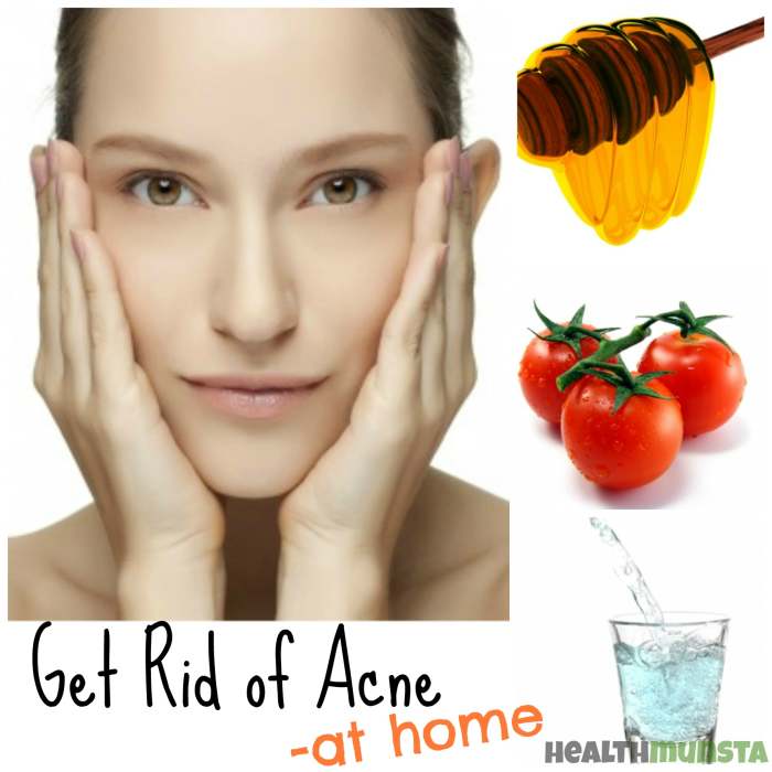 Using simple good habits and natural remedies, you'll be surprised how easy it is to get rid of acne!