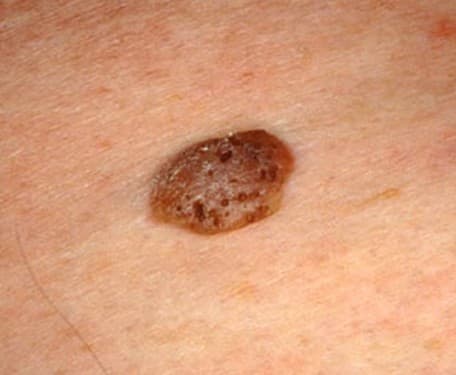 Seborrheic Keratosis - Pictures, Symptoms, Treatment, Removal and ...