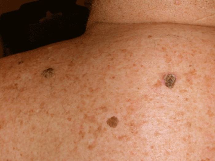 Seborrheic Keratosis Pictures, Symptoms, Treatment, Removal and