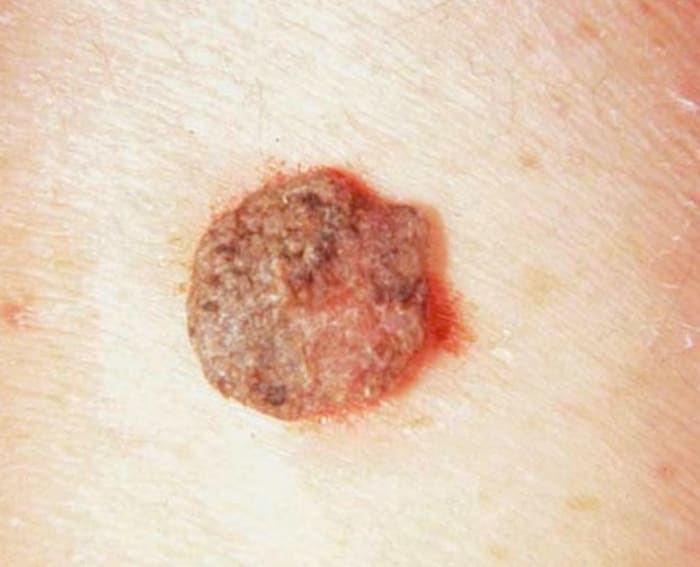 Seborrheic Keratosis - Pictures, Symptoms, Treatment, Removal and ...